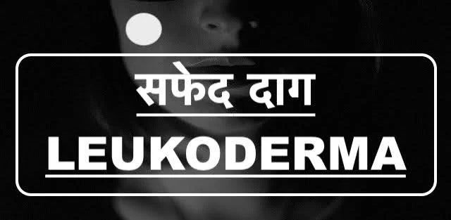 सफेद दाग - leukoderma